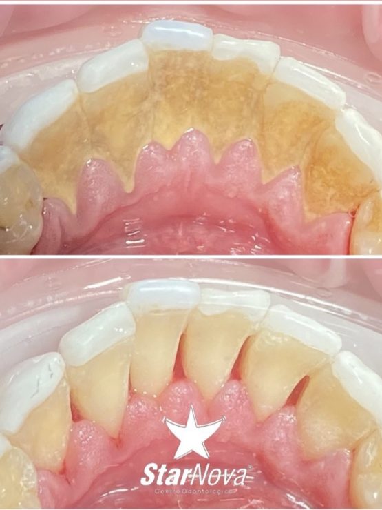 Antes y despues limpiez profunda 2